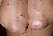 Celiac Symptoms: Skin Rash