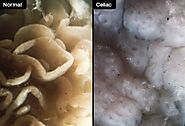 Celiac Damage in the Intestine
