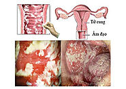 Vùng kín bị ngứa và nổi hạt trắng là bị gì, Cách trị