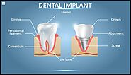 Understanding Dental Implant Coverage: A Comprehensive Guide to Insurance Plan