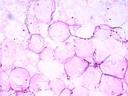 Adipofilling Video Journal