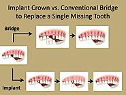 Dental Porcelain Crown and Veneers