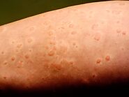 Ayurvedic Treatment for Urticaria - Causes, Symptoms and Ayurvedic remedies for Urticaria relief