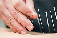 Acupuncture & CRPS