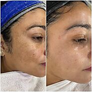 Best Skin Clinic in Chandigarh