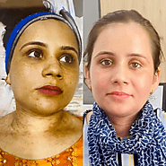 Best Skin Clinic in Chandigarh