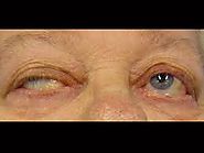 Myasthenia Gravis: a chronic disorder - Natural Herbs Clinic