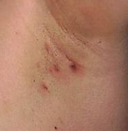 Who Gets Hidradenitis Suppurativa?