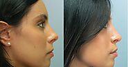 Dubai's Rhinoplasty Wonders: Your Guide to Timeless Beauty