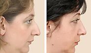 Dubai Dreams: Transform Your Nose with Rhinoplasty Excellence – Site Title