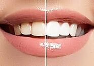 Benefits of Teeth Whitening in Dubai