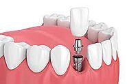 Dental implant in Dubai