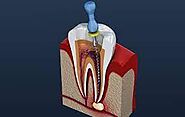 The Ultimate Guide to Painless Root Canal Treatment – Health care