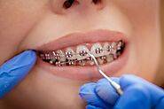 How Long Do I Need to Wear a Retainer After Braces?