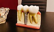 How Dental Implants Can Change Your Life