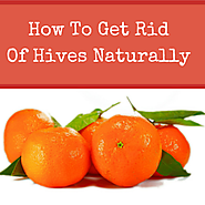 Natural Herbal Remedies: How To Get Rid Of Hives Naturally At Home