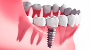 Top 5 Tips for Finding Affordable Dental Implants