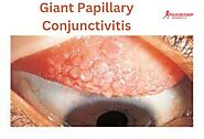 Giant Papillary Conjunctivitis: Managing an Irritating eye Condition. - Health and Fitness Informatics
