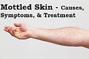 Mottled skin (Livedo Reticularis) Looks Like, Symptoms, Causes, Treatment