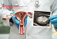 Septate Uterus (Uterine Septum): Causes, Symptoms, and Treatment Options - Health and Fitness Informatics