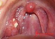 What Causes White Spots on the Throat: Symptoms, and Treatment - Health and Fitness Informatics