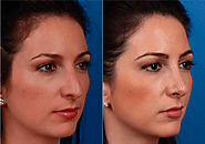 Cambiar la forma de tu nariz en casa ES POSIBLE