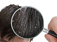 "Unlocking the Secrets of Ayurveda: Natural Solutions for Dandruff-Free Hair"