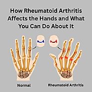 How Rheumatoid Arthritis Affects the Hands and What You Can Do About It - Herbal Care Products - Blog