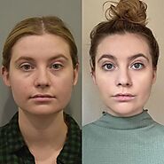 How to Care for Your Incisions After Buccal Fat Removal – SmallBizBlog