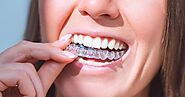Why Invisalign is the Best Option for Clear and Comfortable Teeth Alignment