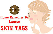 Top 5+ Best Home Remedies To Remove Skin Tags - Beauty & Glamour Tips