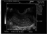 The Uterus : Myometrium & Endometrium