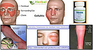 Cellulitis Treatment | Talk also Symptoms, Causes - Herbal Care Products