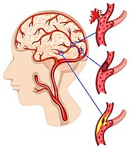 Neurosurgery in India: Advanced Care with Precision and Compassion