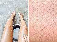 Follicular eczema flare-ups, causes, symptoms, and treatments