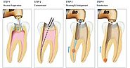 Root Canal Teatment Greensborough