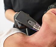 Morpheus8 Face And Body Treatment in Astoria, NY