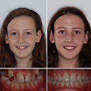 Get your braces fitted this summer