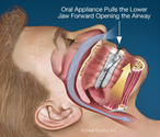 CPAP alternatives for sleep apnea