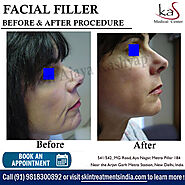 Best Facial Filler Treatment in Delhi