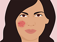 Here's What Your Dermatologist Wants You To Know About Eczema