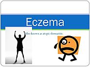 Eczema Powerpoint