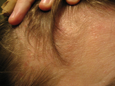9 Natural Remedies for Hair Loss and Hair Thinning