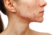 The Benefits of Microdermabrasion for Acne Scars