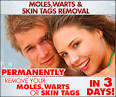 Remove warts, moles and skin tags naturally