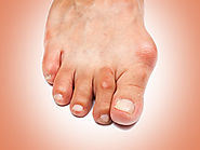 5 Effective ways to treat bunion pain