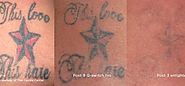 Safest Lasor Tattoo Removal Technique Tweed Heads