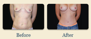 Plastic Surgeon New Jersey, Breast Augmentation - Implants, Tummy Tuck Morristown, Facelift - Dr. Brian Glatt