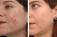 How to Get Rid for Acne Scars? (Home Remedies)