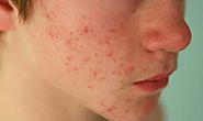 How to Get Rid of Teenage Acne?